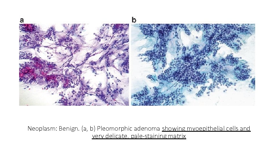 Neoplasm: Benign. (a, b) Pleomorphic adenoma showing myoepithelial cells and very delicate, pale-staining matrix