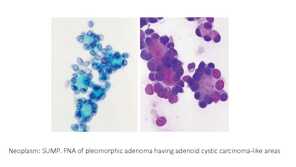 Neoplasm: SUMP. FNA of pleomorphic adenoma having adenoid cystic carcinoma-like areas 