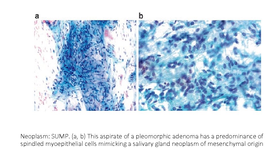 Neoplasm: SUMP. (a, b) This aspirate of a pleomorphic adenoma has a predominance of