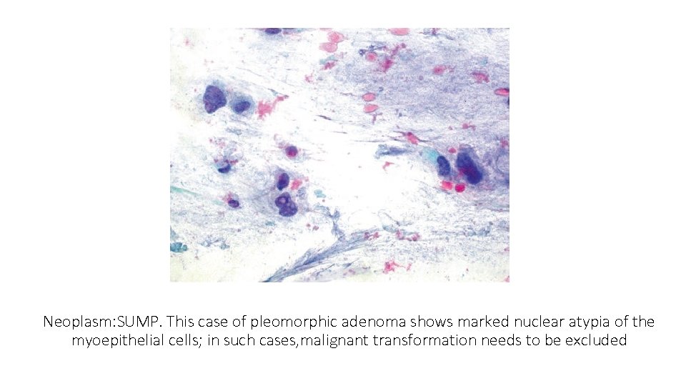 Neoplasm: SUMP. This case of pleomorphic adenoma shows marked nuclear atypia of the myoepithelial