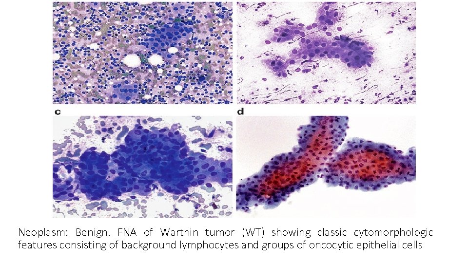 Neoplasm: Benign. FNA of Warthin tumor (WT) showing classic cytomorphologic features consisting of background