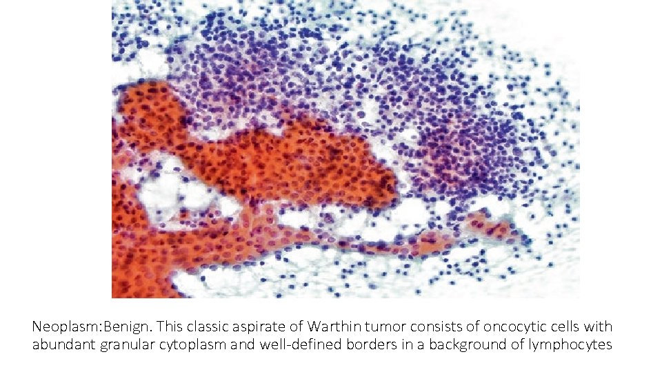 Neoplasm: Benign. This classic aspirate of Warthin tumor consists of oncocytic cells with abundant