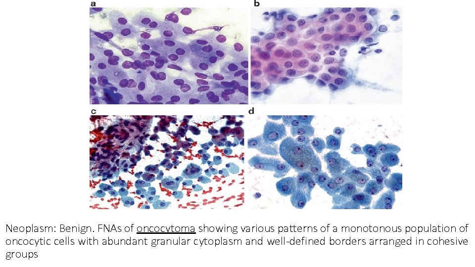 Neoplasm: Benign. FNAs of oncocytoma showing various patterns of a monotonous population of oncocytic