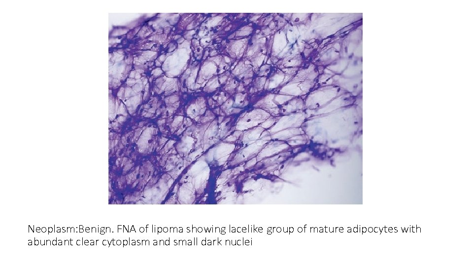 Neoplasm: Benign. FNA of lipoma showing lacelike group of mature adipocytes with abundant clear