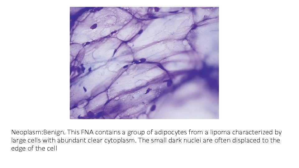 Neoplasm: Benign. This FNA contains a group of adipocytes from a lipoma characterized by