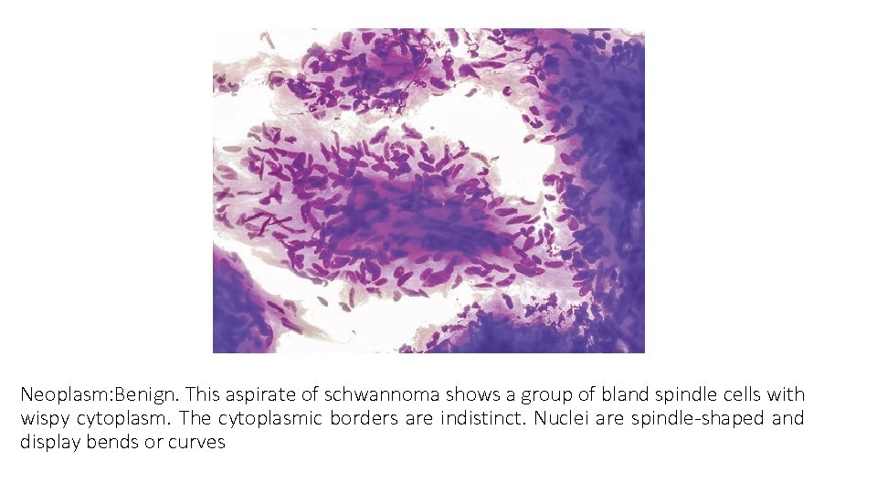 Neoplasm: Benign. This aspirate of schwannoma shows a group of bland spindle cells with