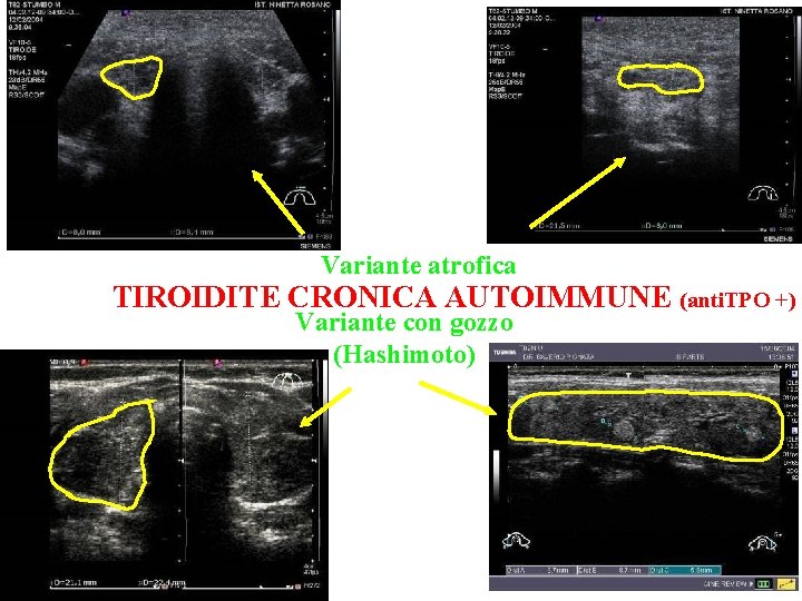 Variante atrofica TIROIDITE CRONICA AUTOIMMUNE (anti. TPO +) Variante con gozzo (Hashimoto) 