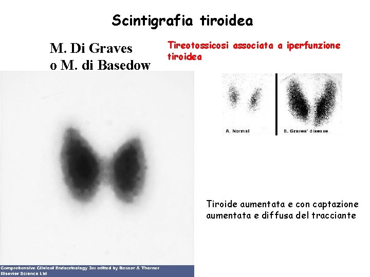 Scintigrafia tiroidea M. Di Graves o M. di Basedow Tireotossicosi associata a iperfunzione tiroidea