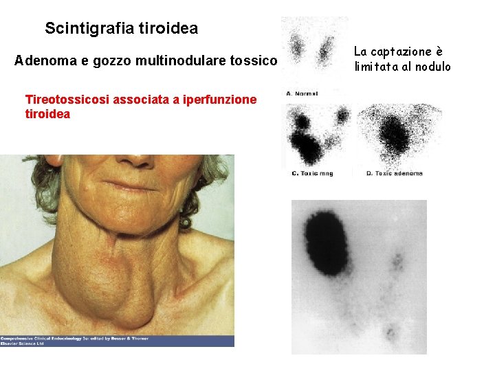 Scintigrafia tiroidea Adenoma e gozzo multinodulare tossico Tireotossicosi associata a iperfunzione tiroidea La captazione