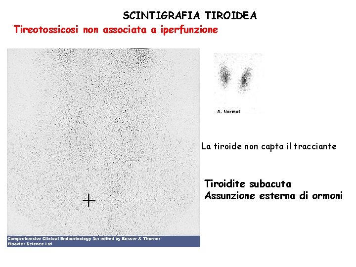 SCINTIGRAFIA TIROIDEA Tireotossicosi non associata a iperfunzione La tiroide non capta il tracciante Tiroidite