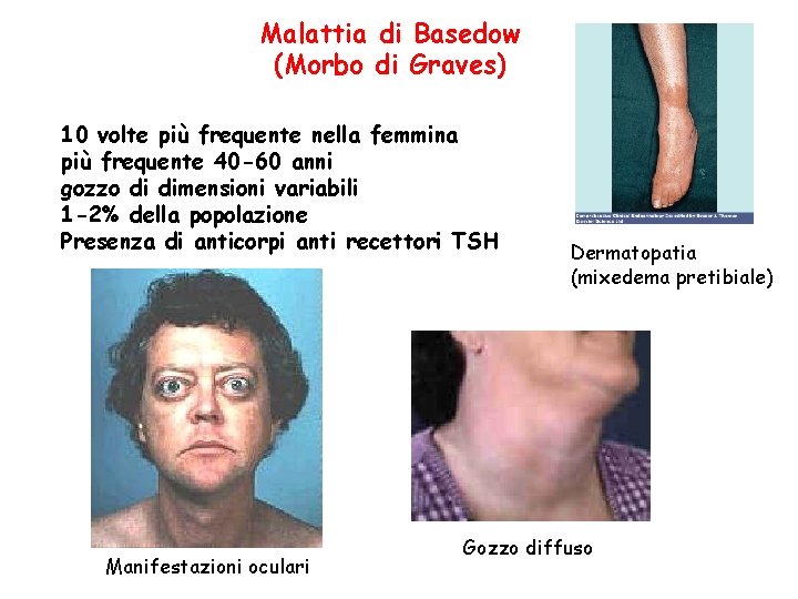 Malattia di Basedow (Morbo di Graves) 10 volte più frequente nella femmina più frequente