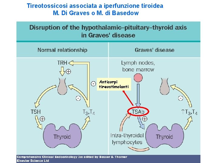 Tireotossicosi associata a iperfunzione tiroidea M. Di Graves o M. di Basedow Anticorpi tireostimolanti