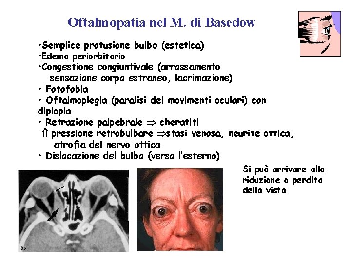 Oftalmopatia nel M. di Basedow • Semplice protusione bulbo (estetica) • Edema periorbitario •
