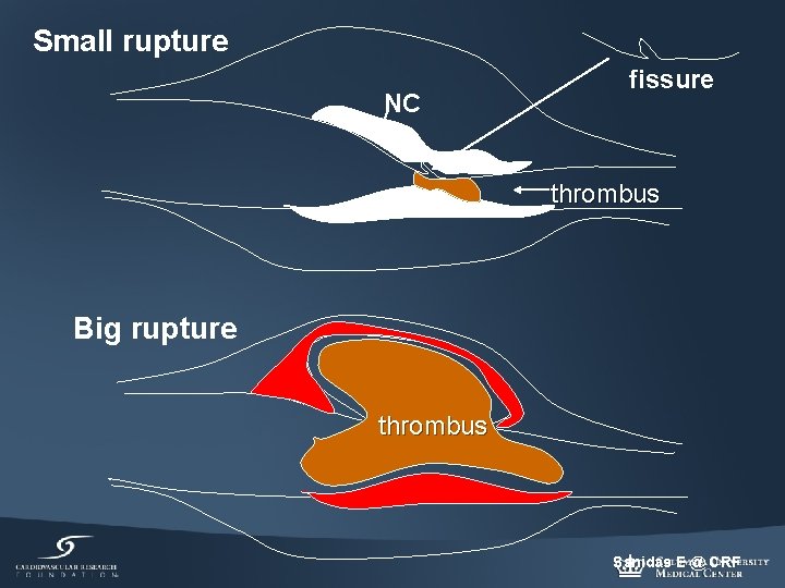 Small rupture NC fissure thrombus Big rupture thrombus Sanidas E @ CRF 