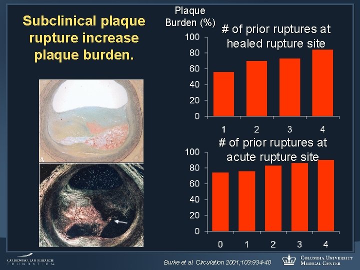 Subclinical plaque rupture increase plaque burden. Plaque Burden (%) # of prior ruptures at