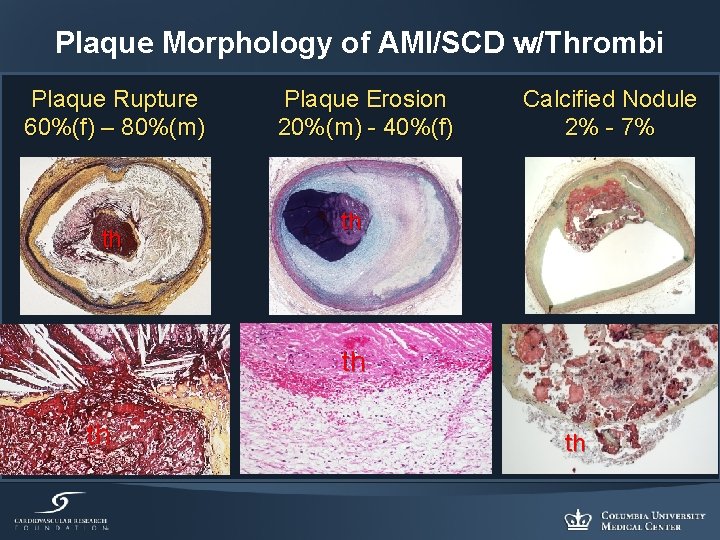 Plaque Morphology of AMI/SCD w/Thrombi Plaque Rupture 60%(f) – 80%(m) th Plaque Erosion 20%(m)