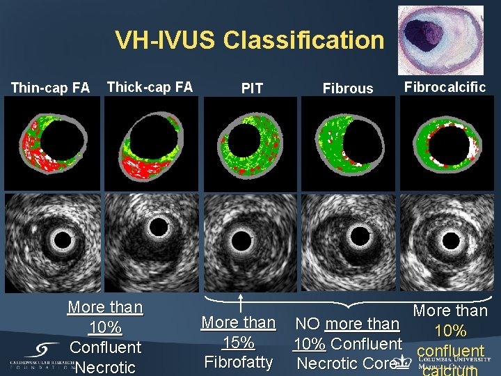 VH-IVUS Classification Thin-cap FA Thick-cap FA More than 10% Confluent Necrotic PIT Fibrous Fibrocalcific