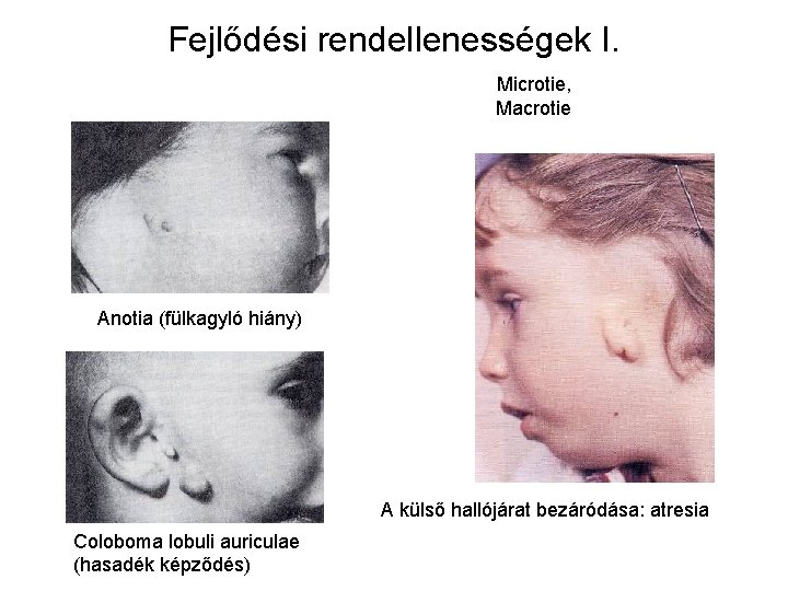 Fejlődési rendellenességek I. Microtie, Macrotie Anotia (fülkagyló hiány) A külső hallójárat bezáródása: atresia Coloboma