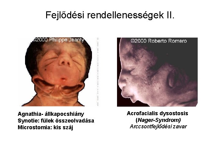 Fejlődési rendellenességek II. Agnathia- állkapocshiány Synotie: fülek összeolvadása Microstomia: kis száj Acrofacialis dysostosis (Nager-Syndrom)