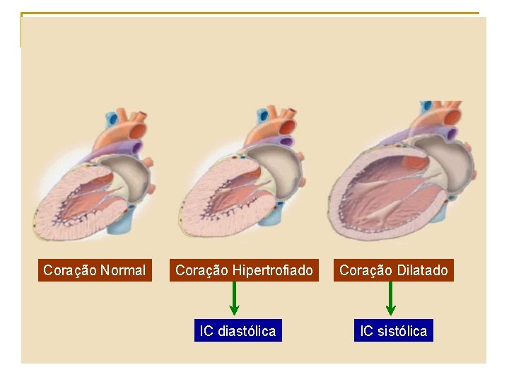 Coração Normal Coração Hipertrofiado IC diastólica Coração Dilatado IC sistólica 