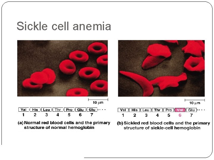 Sickle cell anemia 