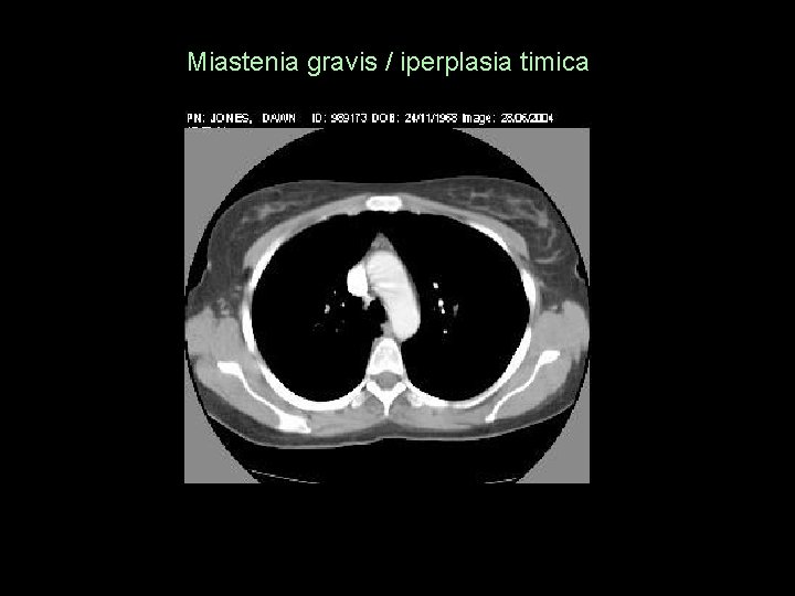Miastenia gravis / iperplasia timica 