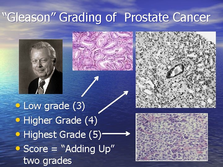 “Gleason” Grading of Prostate Cancer • Low grade (3) • Higher Grade (4) •