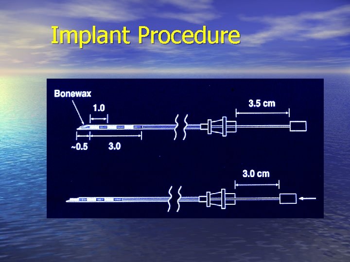 Implant Procedure 