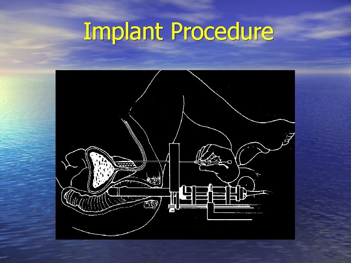 Implant Procedure 