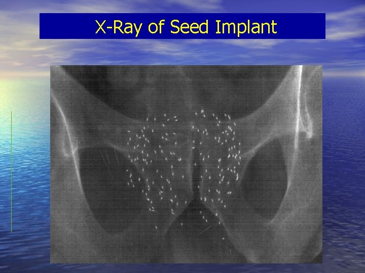 X-Ray of Seed Implant 