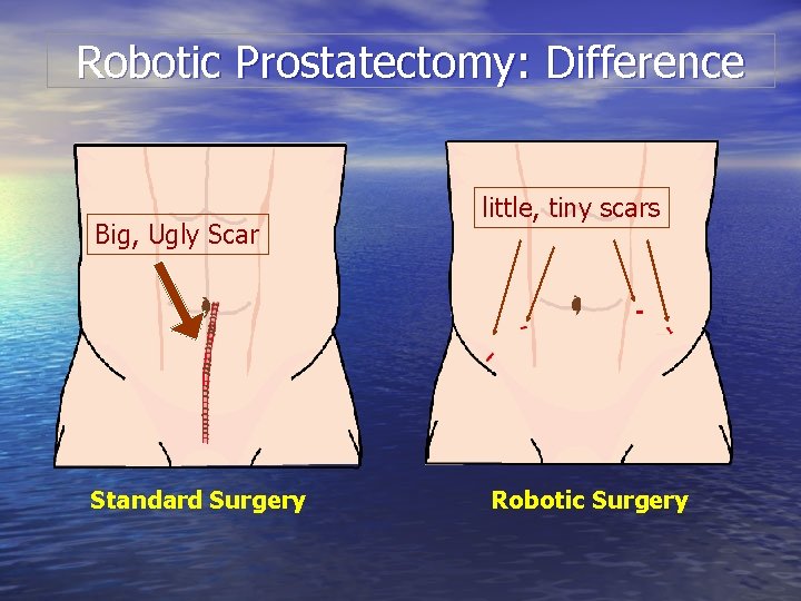 Robotic Prostatectomy: Difference Big, Ugly Scar Standard Surgery little, tiny scars Robotic Surgery 