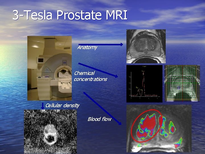 3 -Tesla Prostate MRI Anatomy Chemical concentrations Cellular density Blood flow 