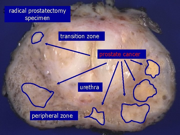 radical prostatectomy specimen transition zone prostate cancer urethra peripheral zone 