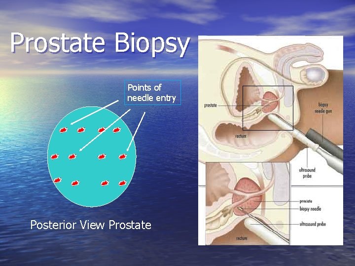 Prostate Biopsy Points of needle entry Posterior View Prostate 