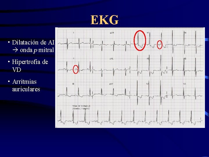 EKG • Dilatación de AI onda p mitral • Hipertrofia de VD • Arritmias