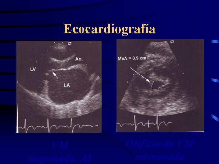 Ecocardiografía VM engrosada, AI Orificio de VM estenosado 