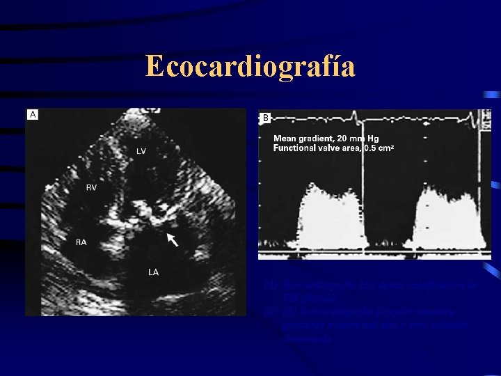 Ecocardiografía (A) Ecocardiografía 2 D: densa calcificación de VM (flecha) (B) Ecocardiografía Doppler: muestra