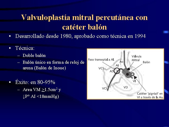 Valvuloplastía mitral percutánea con catéter balón • Desarrollado desde 1980, aprobado como técnica en