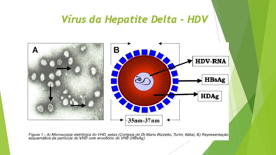 Vírus da Hepatite Delta – HDV 