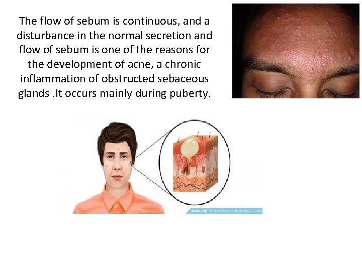 The flow of sebum is continuous, and a disturbance in the normal secretion and