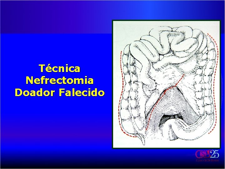 Técnica Nefrectomia Doador Falecido 