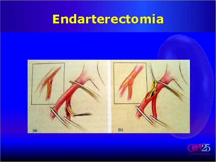 Endarterectomia 