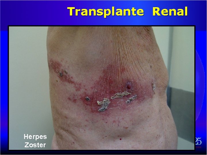 Transplante Renal Herpes Zoster 