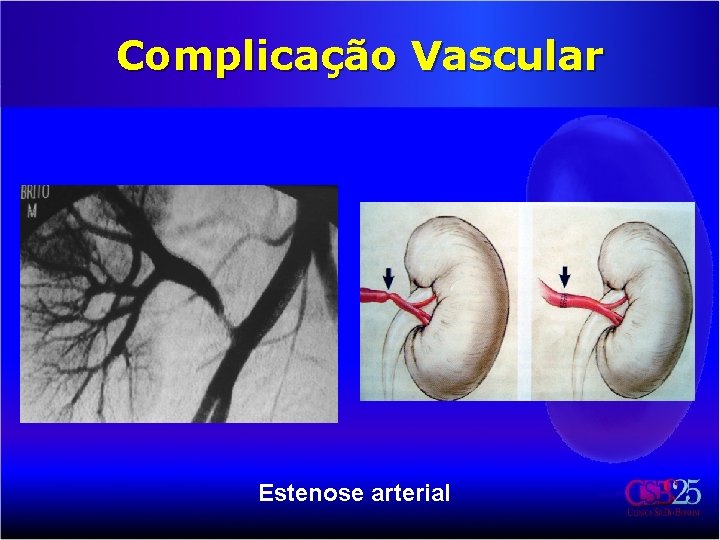 Complicação Vascular Estenose arterial 