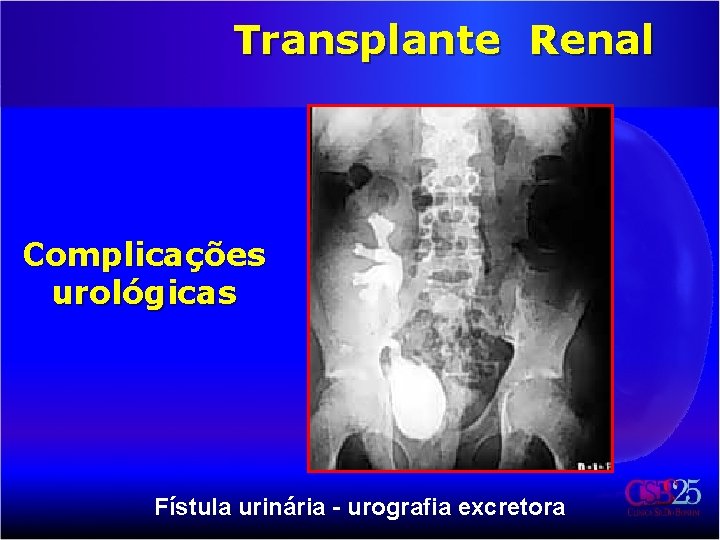 Transplante Renal Complicações urológicas Fístula urinária - urografia excretora 