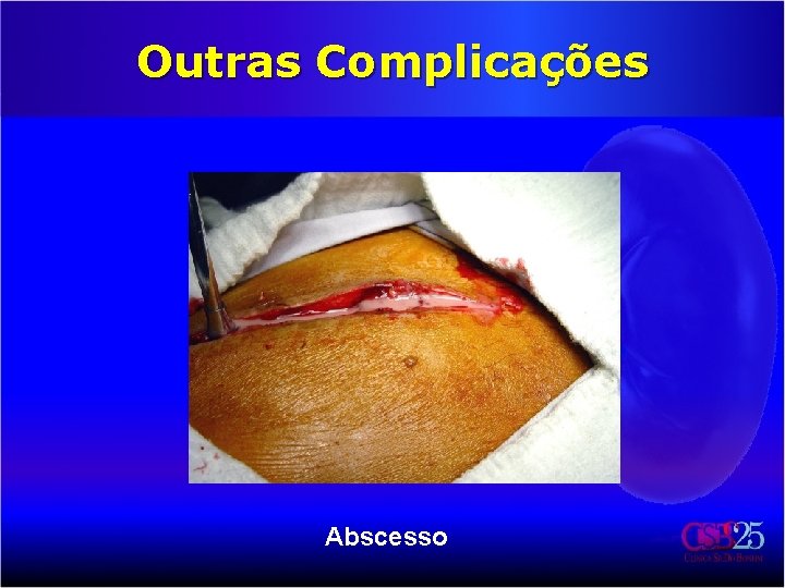 Outras Complicações Abscesso 