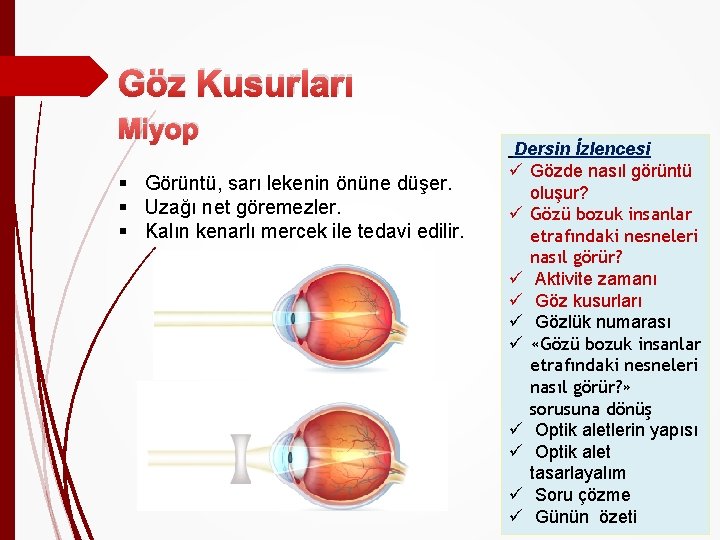 Göz Kusurları Miyop § Görüntü, sarı lekenin önüne düşer. § Uzağı net göremezler. §