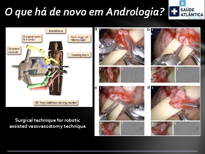 O que há de novo em Andrologia? Surgical technique for robotic assisted vasostomy technique
