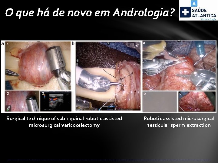 O que há de novo em Andrologia? Surgical technique of subinguinal robotic assisted microsurgical