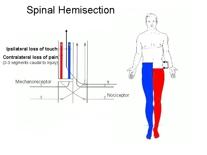 Spinal Hemisection Ipsilateral loss of touch… Contralateral loss of pain… (2 -3 segments caudal
